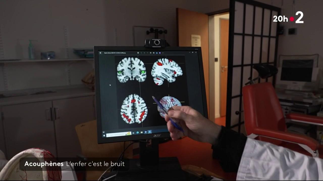 Quasi 10 milioni di francesi soffrono di acufene.  Sono i segnali acustici, quei ronzii che sentiamo continuamente che ti fanno impazzire.  L’età media di insorgenza della malattia è di circa 47 anni.  Spesso è l’eccessiva esposizione al rumore a provocarlo.  Ma in circa il 40% dei casi la causa dell’acufene è sconosciuta.